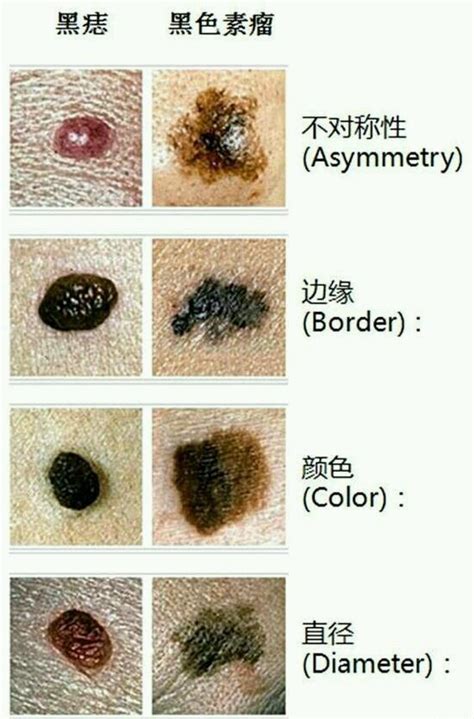 全身都是痣|你身上的痣会癌变吗？医生分析了100多颗黑痣，快来对照下！